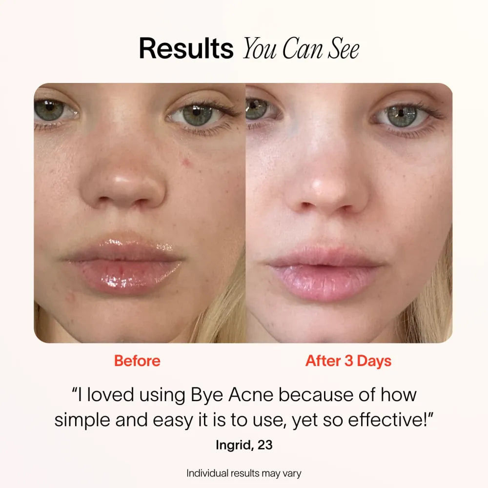 Bye Acne 3minute Pimple Spot Treatment Cosmopolitan Shop